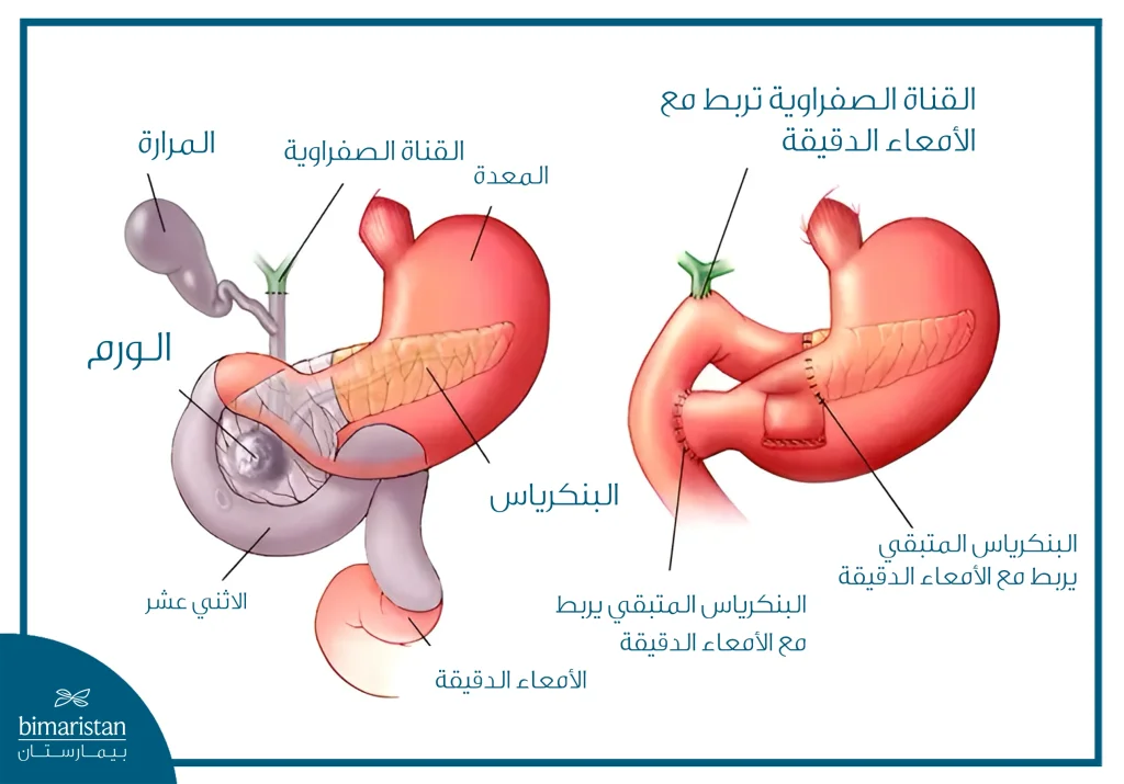 توضح عملية ويبل لإزالة جزء من البنكرياس والأعضاء المصابة وإعادة توصيل الجهاز الهضمي المستخدمة في علاج سرطان البنكرياس