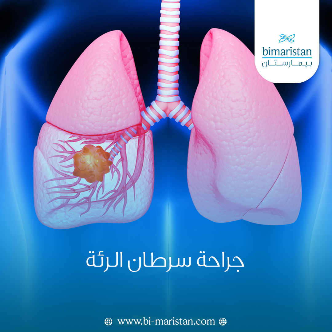 جراحة سرطان الرئة