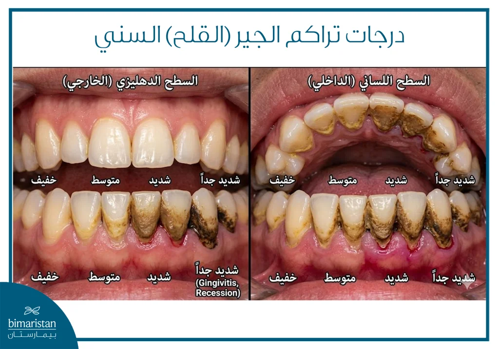 درجات تراكم الجير (القلح) السني
