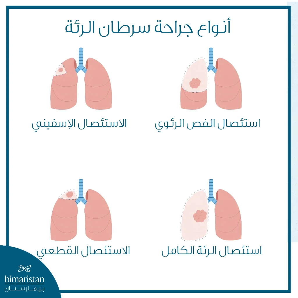 رسم توضيحي يشرح الخيارات الجراحية المختلفة المستخدمة لعلاج سرطان الرئة بحسب حجم الورم وموقعه وامتداده