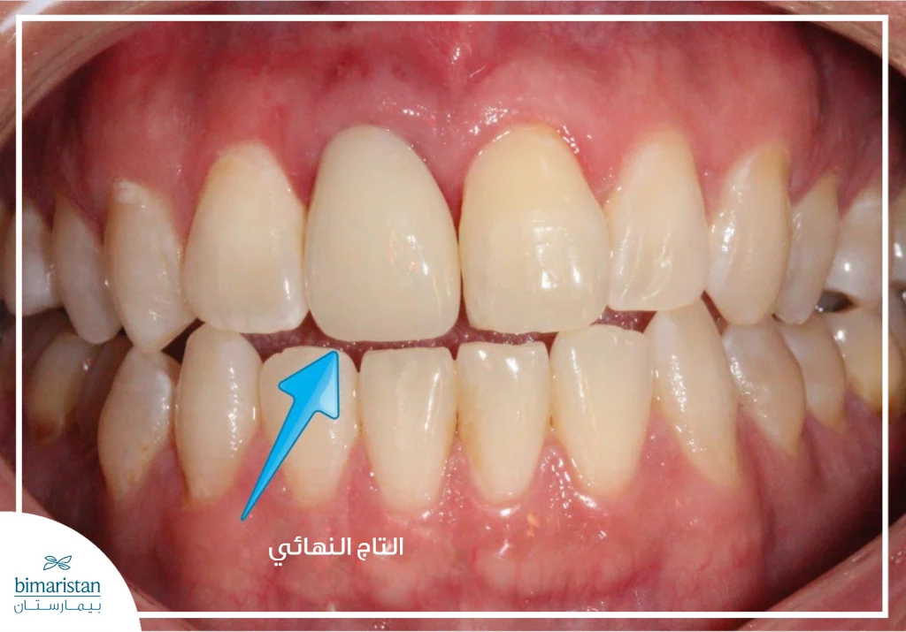 صورة تبين توضع الزرعة وتركيب التاج النهائي وتناسقها مع باقي الأسنان شكلًا ولونًا