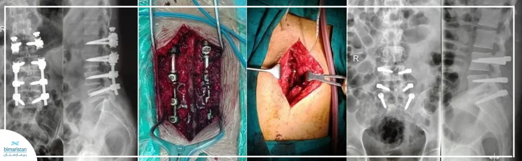 صورة تظهر التثبيت المتحرك للفقرات القطنية