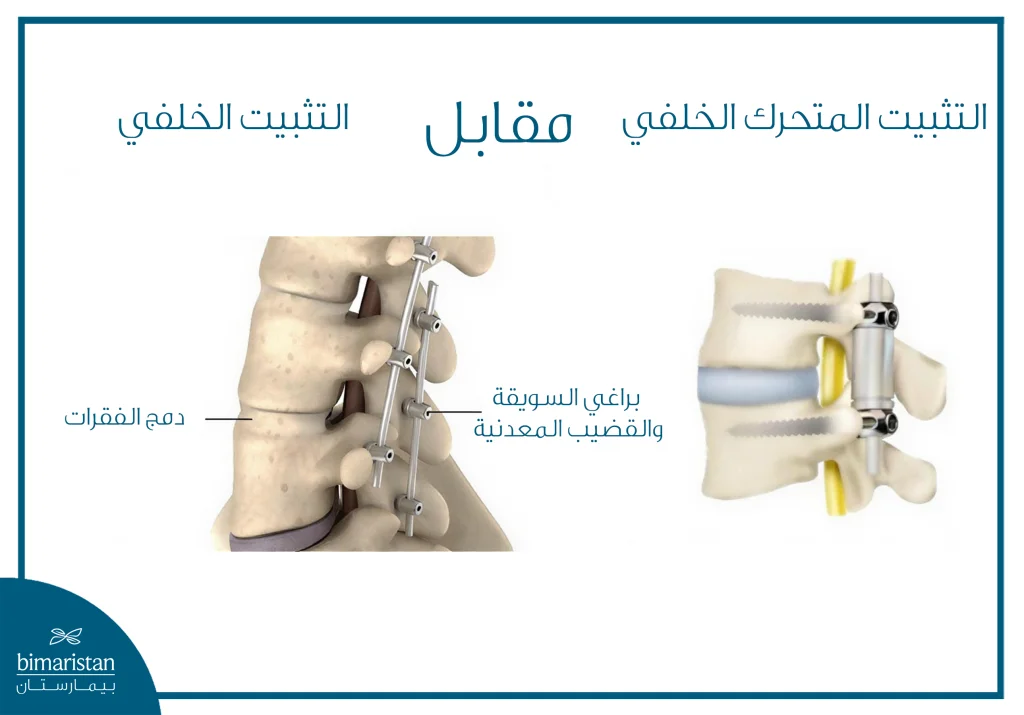 صورة تظهر الفرق بين التثبيت المتحرك والثابت للفقرات القطنية