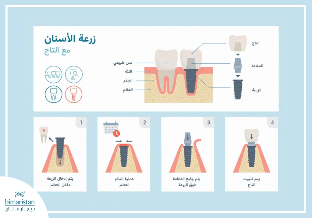 صورة توضيحية تبين مراحل زراعة الأسنان