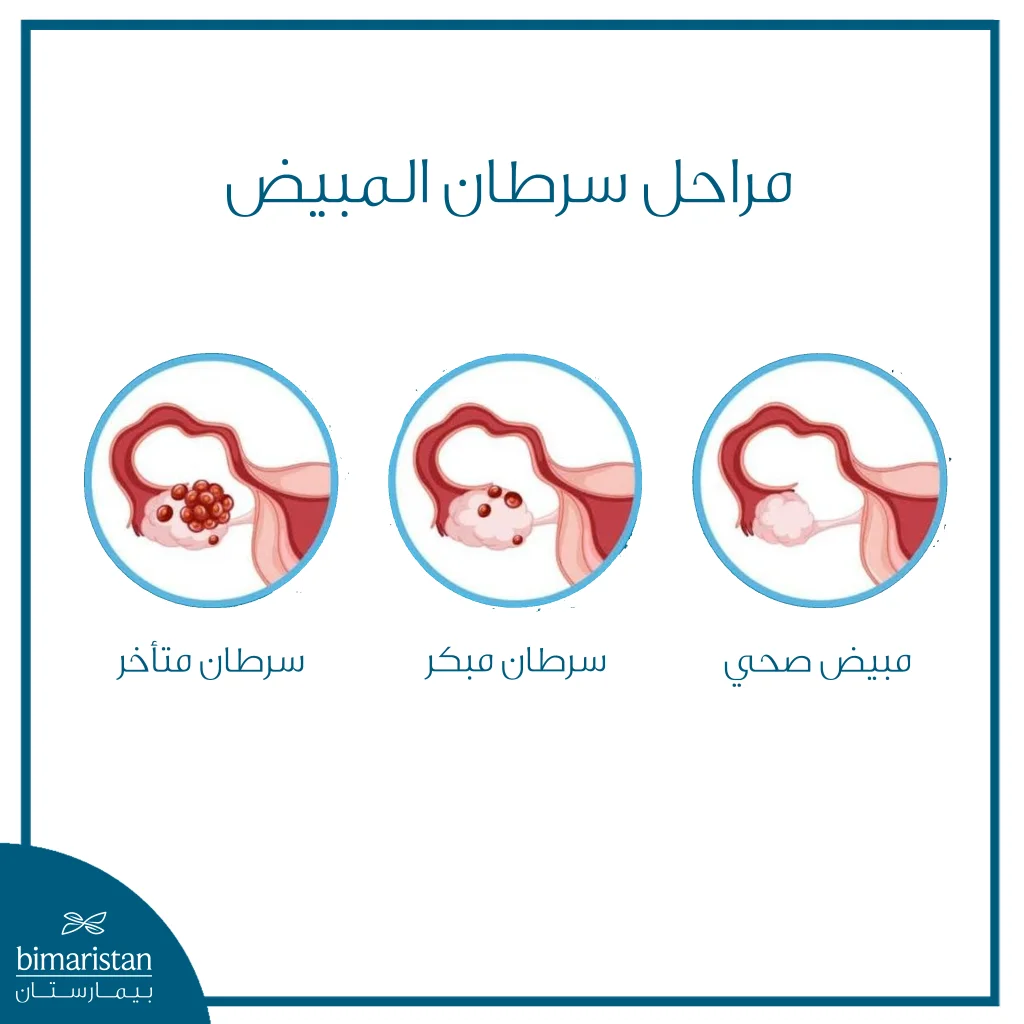 صورة توضيحية تقارن بين المبيض السليم وسرطان المبيض في مرحلة مبكرة ومرحلة متأخرة.