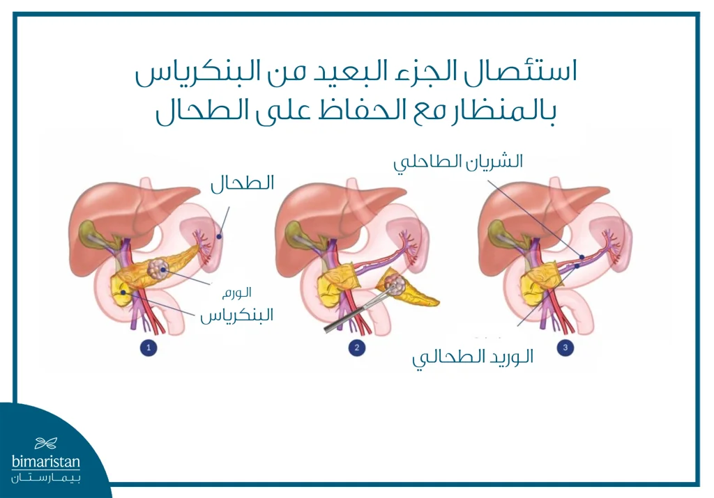 علاج سرطان رأس البنكرياس: أحدث الطرق الجراحية ونسب الشفاء 6 تُظهر الصورة عملية استئصال الجزء البعيد من البنكرياس بالمنظار مع الحفاظ على الطحال، وهي جراحة تُستخدم لعلاج سرطان رأس البنكرياس، حيث يتم إزالة الجزء المصاب مع الحفاظ على الطحال والأوعية الدموية المرتبطة به قدر الإمكان.