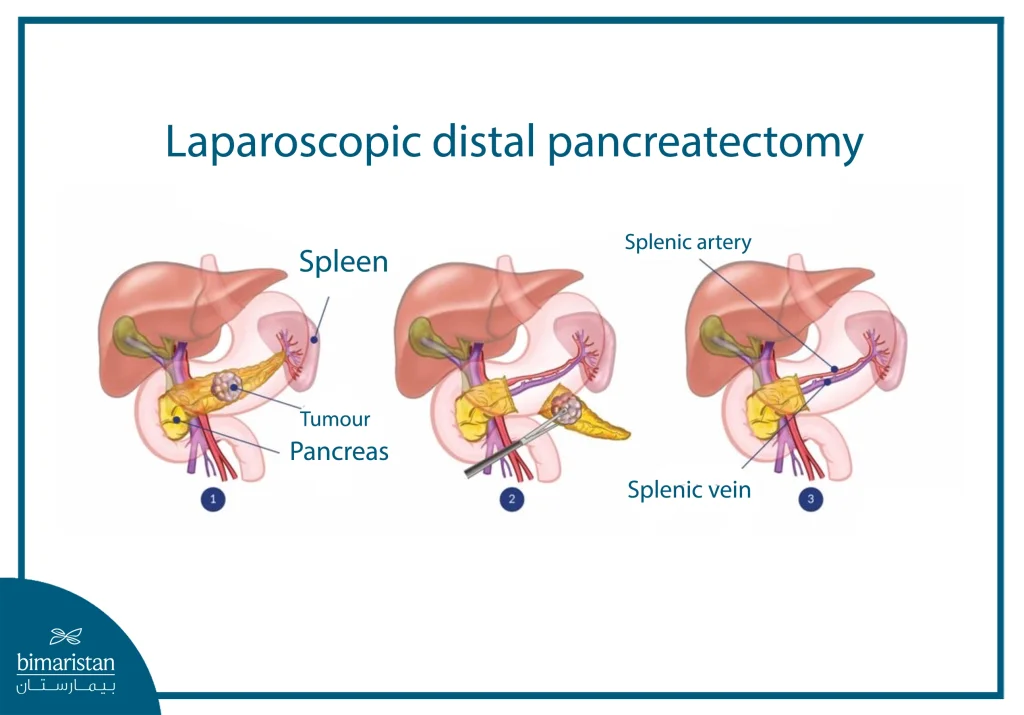 Treatment For Pancreatic Head Cancer: The Latest Surgical Methods And Cure Rates 5 The Image Illustrates A Laparoscopic Distal Pancreatectomy With Spleen Preservation, A Surgical Procedure Used To Remove Tumors Located In The Body Or Tail Of The Pancreas While Preserving The Spleen And Its Blood Vessels Whenever Possible. .Webp