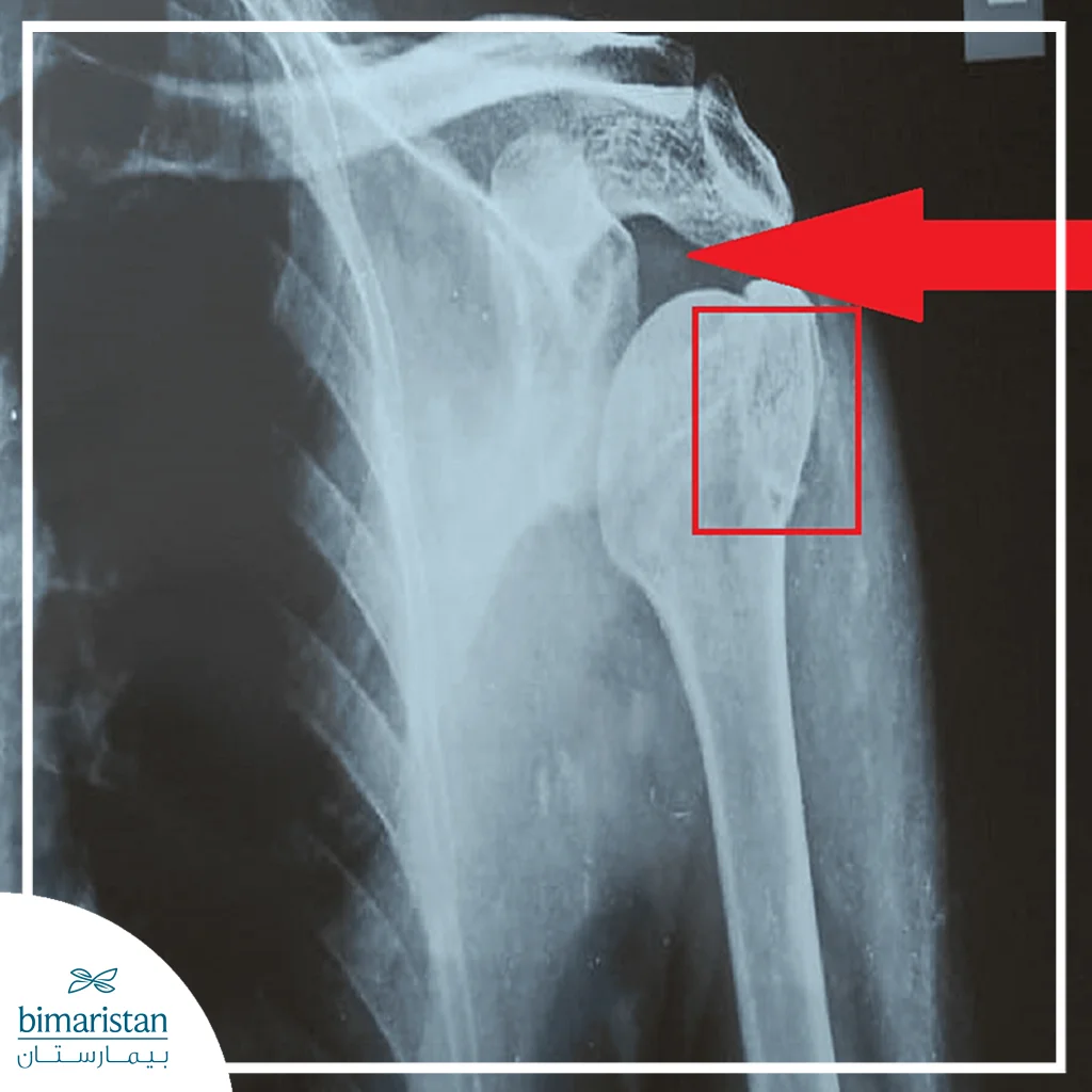 An X-Ray Image Showing A Clearly Visible Shoulder Fracture.