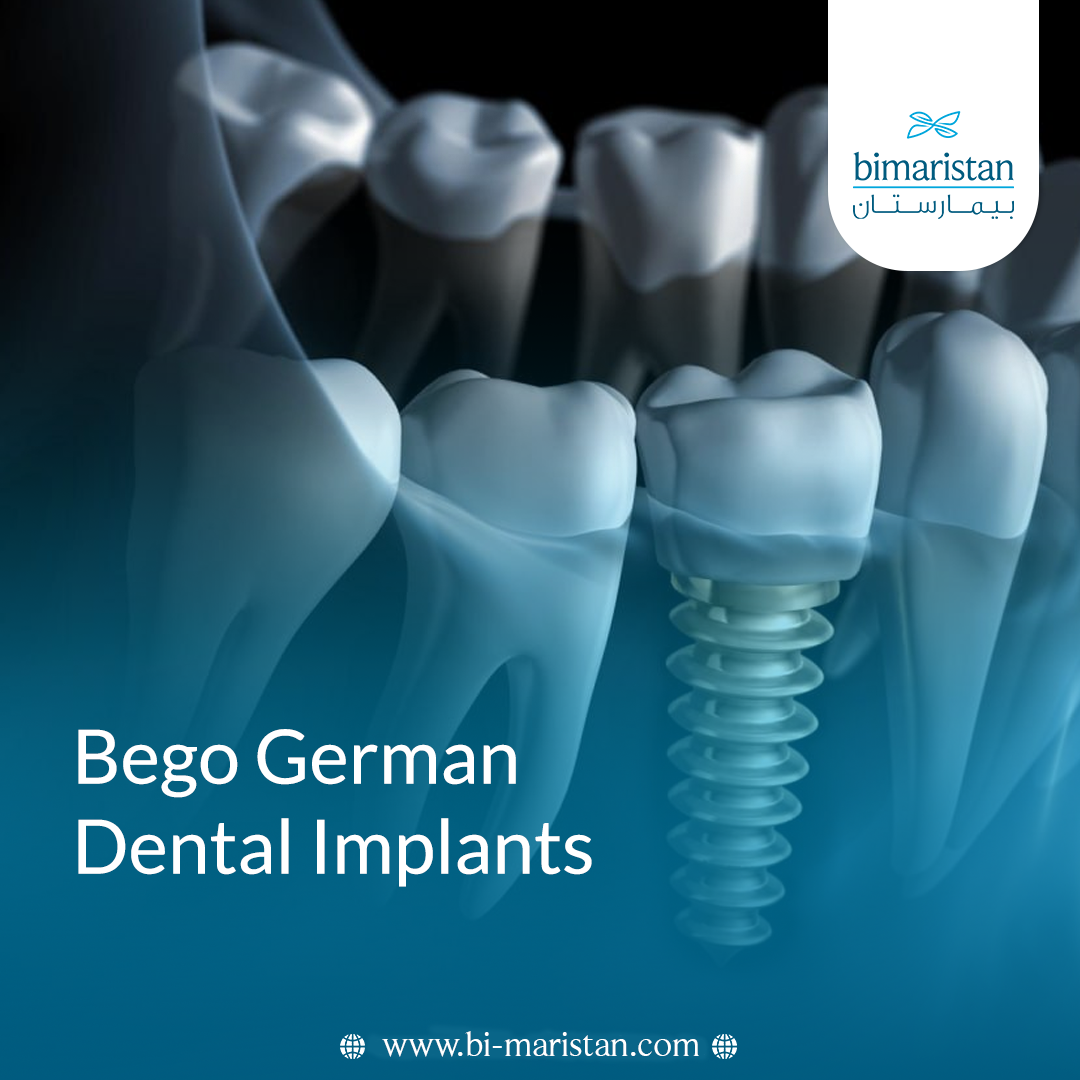 Bego German Dental Implants: Quality And Long-Lasting Results 8 Bego German Dental Implants: Quality And Long-Lasting Results
