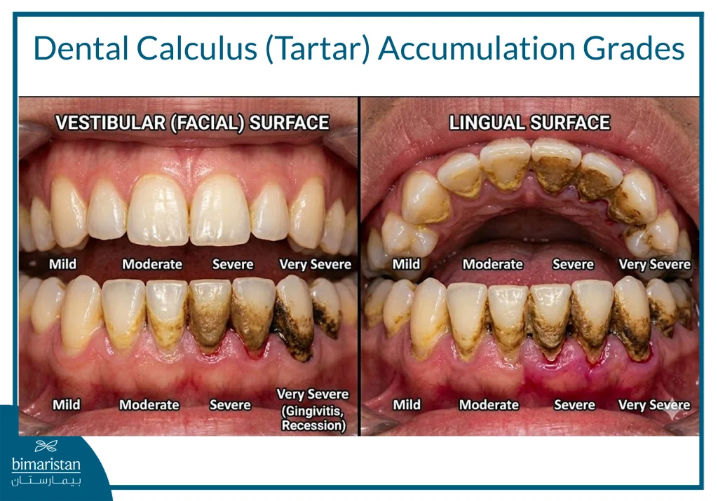 Dental Calculus (Tartar) Accumulation Grades