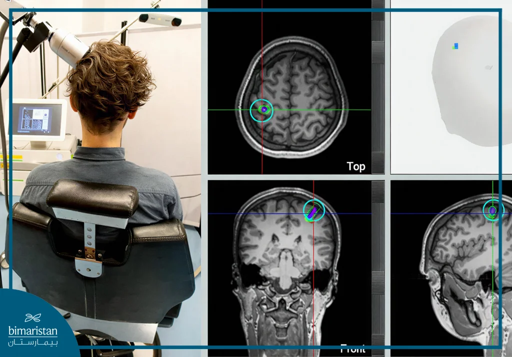 Focal Transcranial Pulse Stimulation