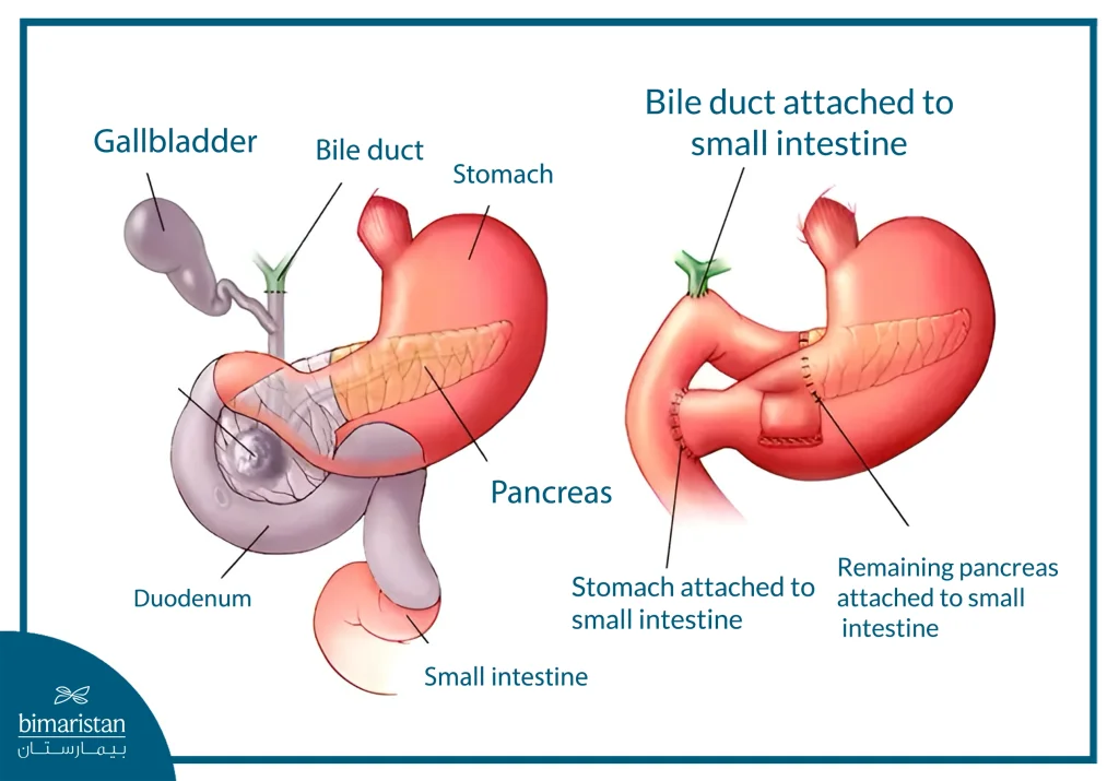 Illustrates The Whipple Surgery Removing Part Of The Pancreas And Reconnecting The Digestive Tract.