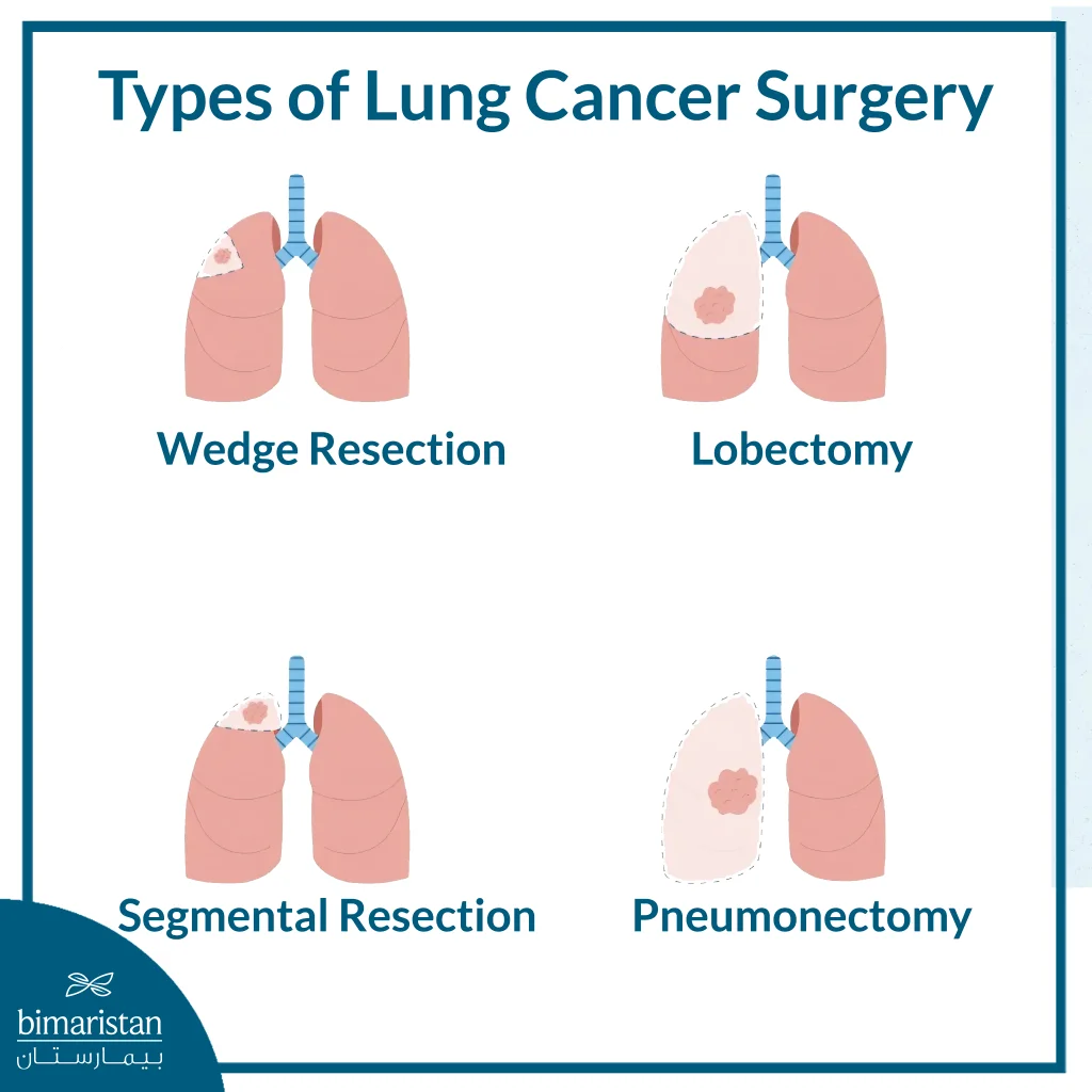 Illustration Explaining The Different Surgical Approaches Used To Treat Lung Cancer Based On The Tumor’s Size, Location, And Extent