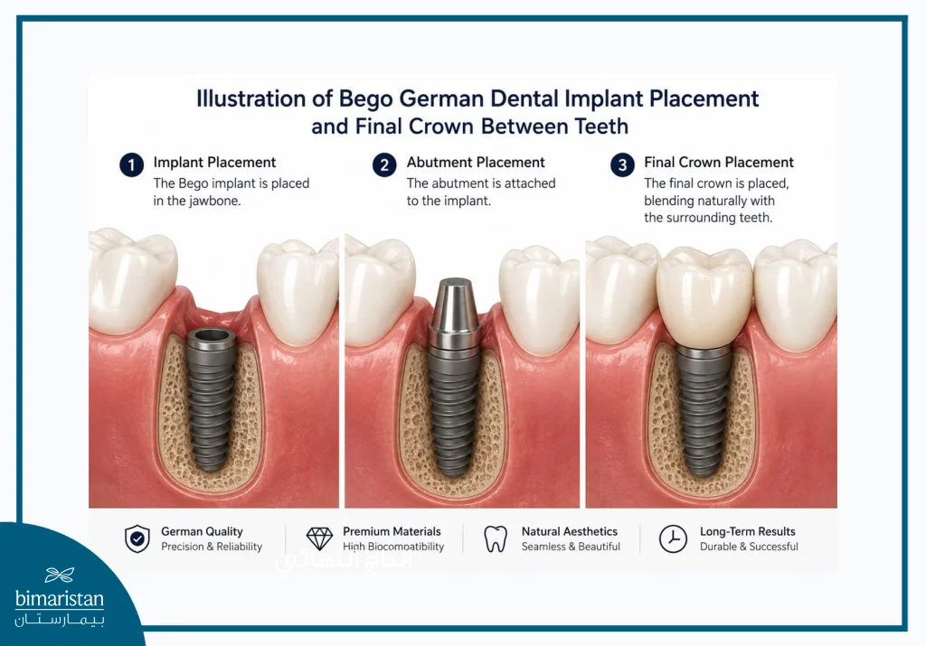 Bego German Dental Implants: Quality And Long-Lasting Results 2 Illustration Of A Bego German Dental Implant Placement With The Final Crown Integrated Among Adjacent Teeth