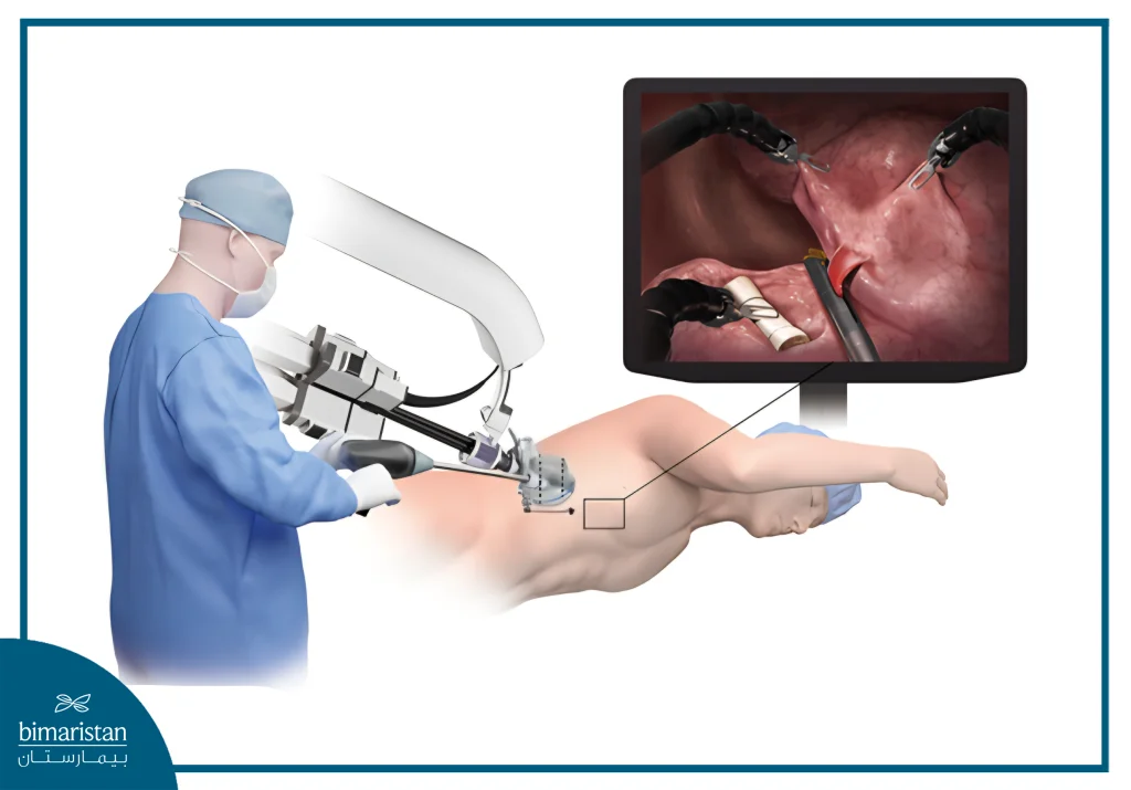 Illustration Of Single-Port (Uniportal) Video-Assisted Thoracoscopic Surgery (Vats) For Lung Cancer Through A Single Small Incision, With The Surgical View Inside The Chest Displayed