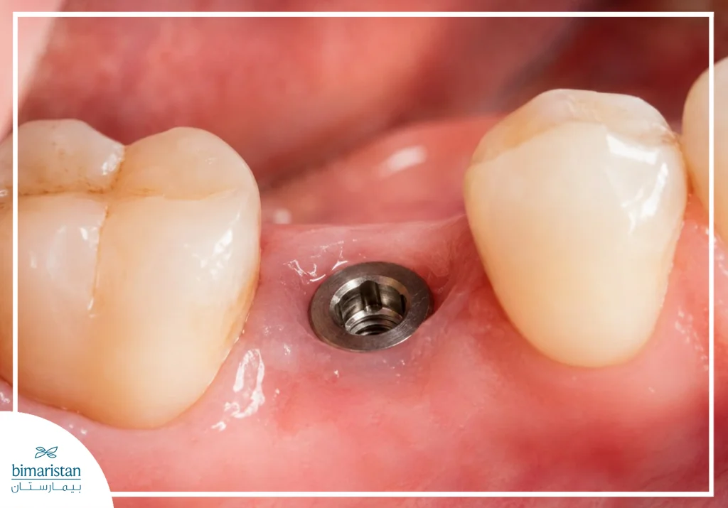 Swiss Nobel Dental Implants: Precision And Quality In Dental Implantology 3 Illustrative Image Of A Swiss Nobel Dental Implant Inside The Mouth, Highlighting The Implant'S Stability And Its Natural Integration With The Surrounding Teeth And Gum Tissue.