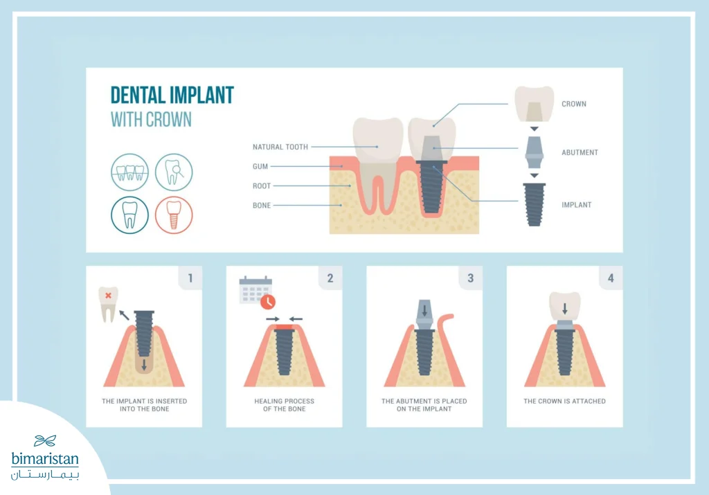 Bego German Dental Implants: Quality And Long-Lasting Results 3 Illustrative Image Showing The Stages Of Dental Implant Placement.