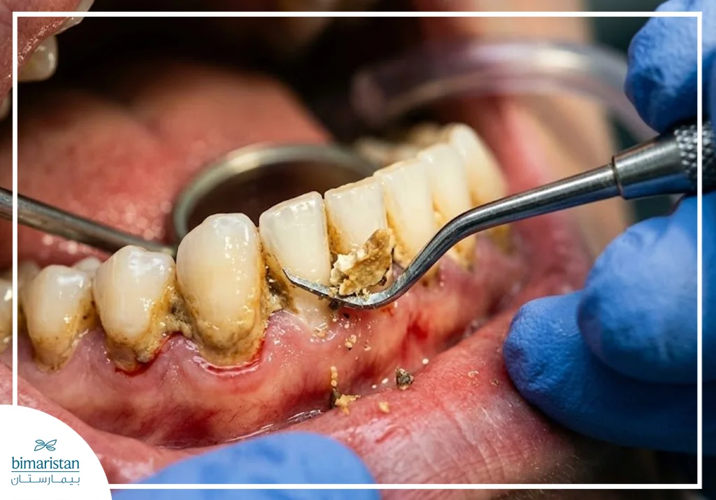 Image Illustrating Dental Calculus (Tartar) Removal And Teeth Scaling