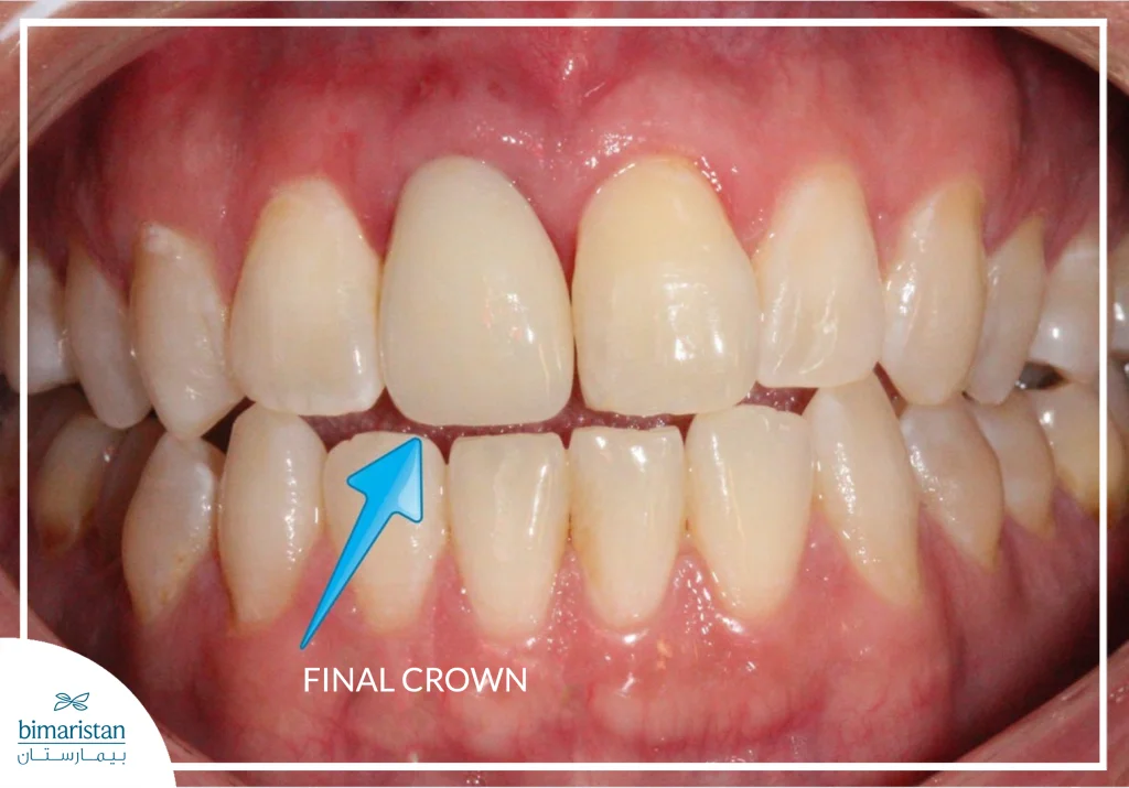 Image Showing Implant Placement And The Final Crown Blending Naturally With Adjacent Teeth