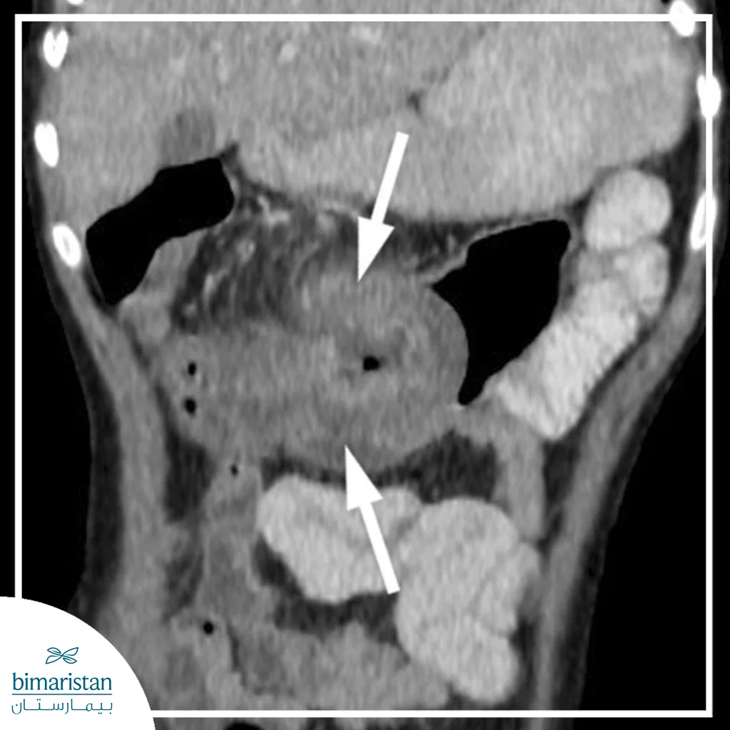 Image Showing A Tumor In The Digestive Tract
