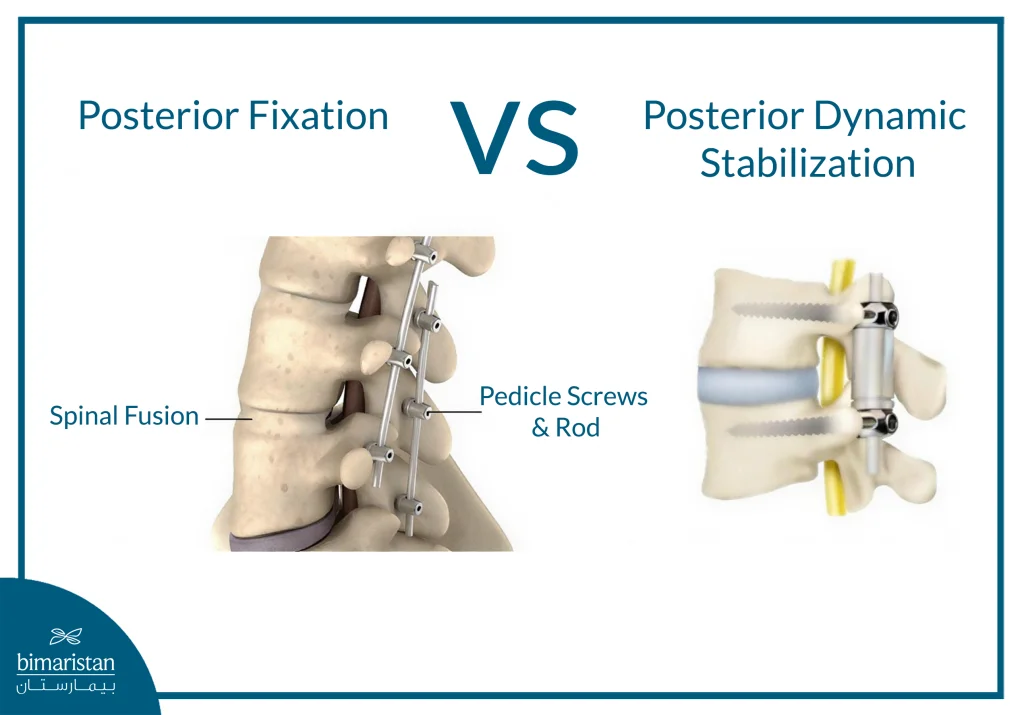 Dynamic Lumbar Stabilization : A Modern Solution For Relieving Back Pain While Preserving Mobility 4 Image Showing The Difference Between Dynamic And Fixed Lumbar Vertebrae Fixation