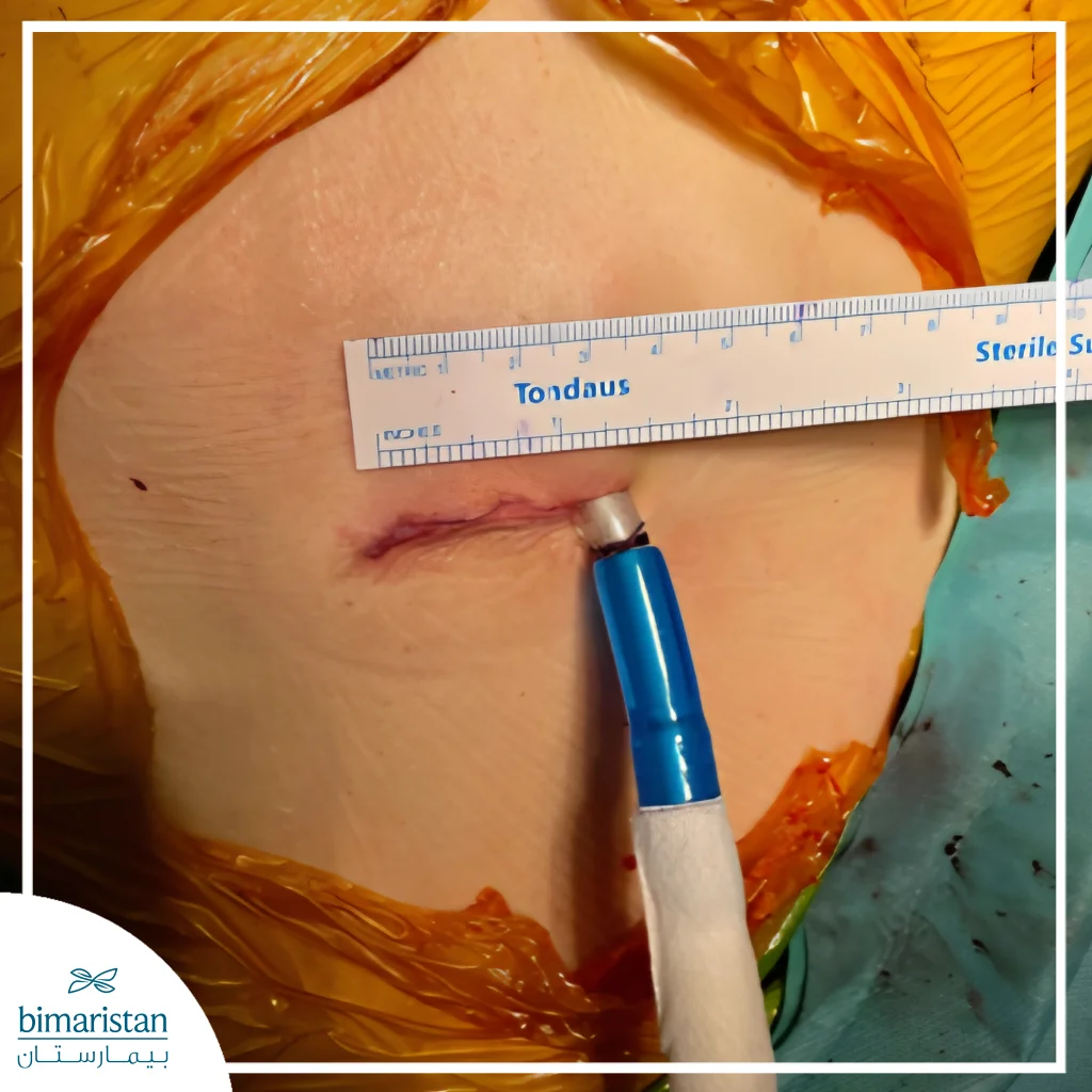 An Image Showing The Minimal Surgical Incision Used In Single‑Port Thoracoscopy, Which Helps Reduce Pain And Speed Up Recovery