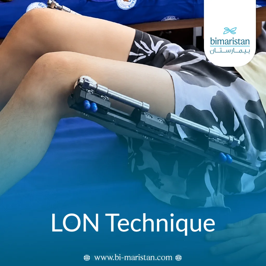 Lon Technique For Bone Lengthening: Method, Applications, Advantages, And Cost 8 Lon Technique