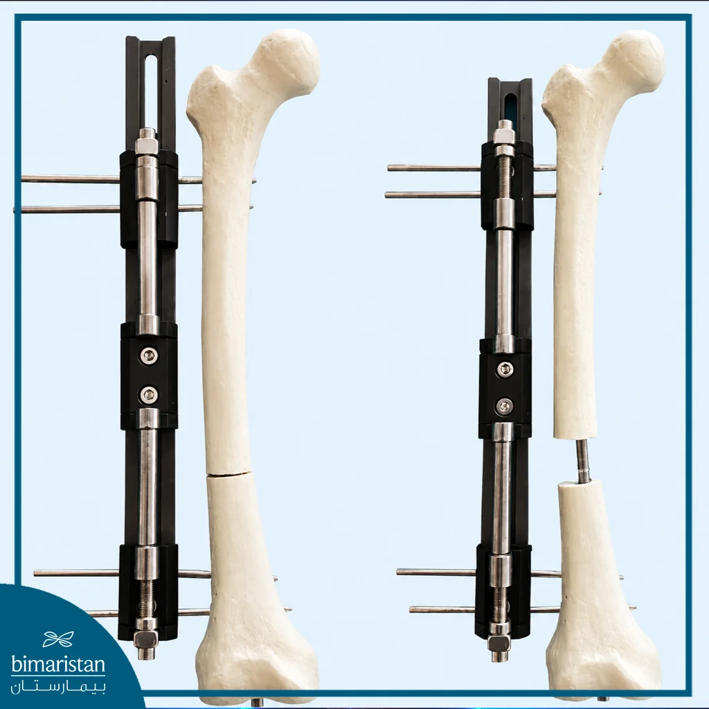Lon Technique For Bone Lengthening: Method, Applications, Advantages, And Cost 5 Lon Technique Everything You Need To Know About It