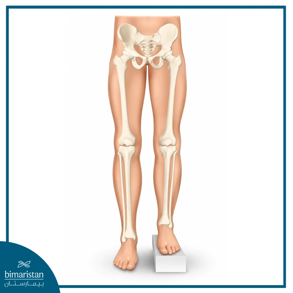 Lon Technique For Bone Lengthening: Method, Applications, Advantages, And Cost 6 Limb Length Discrepancy One Of The Main Indications For The Lon Technique.