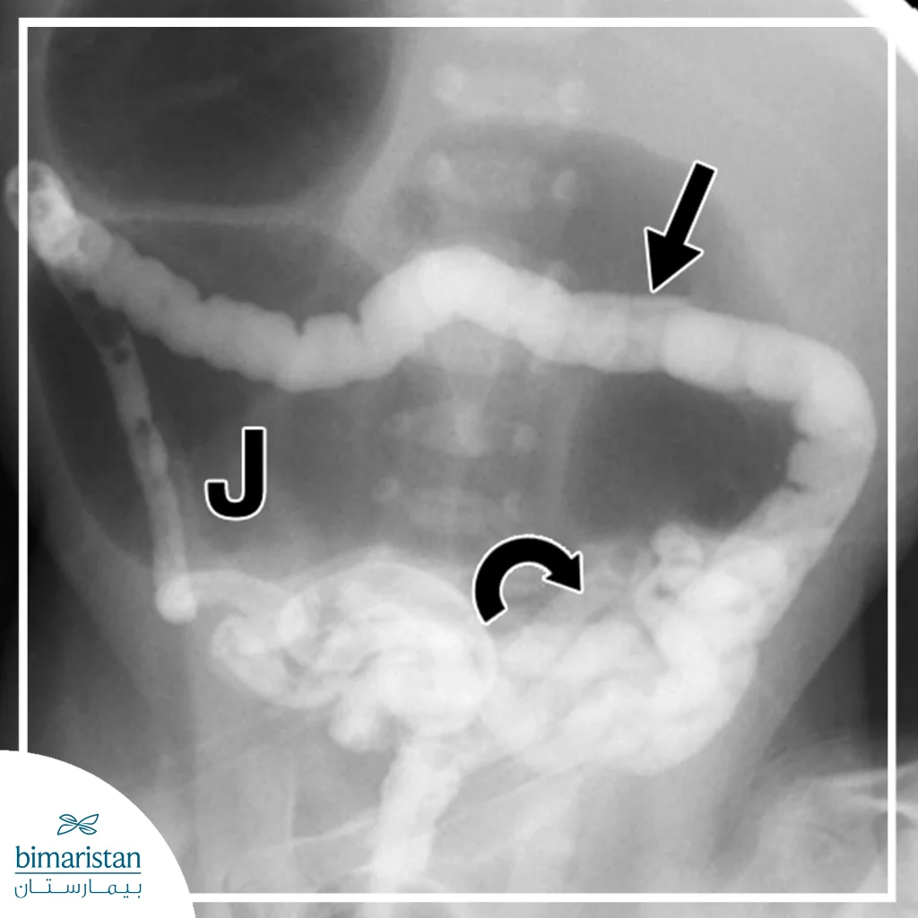 Neonatal Intestinal Obstruction 2 Neonatal Intestinal Obstruction1