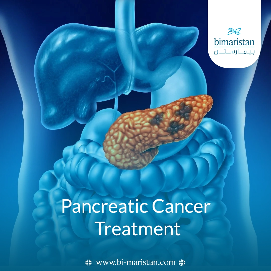 Pancreatic Cancer Treatment: Surgery, Chemotherapy, And Modern Options