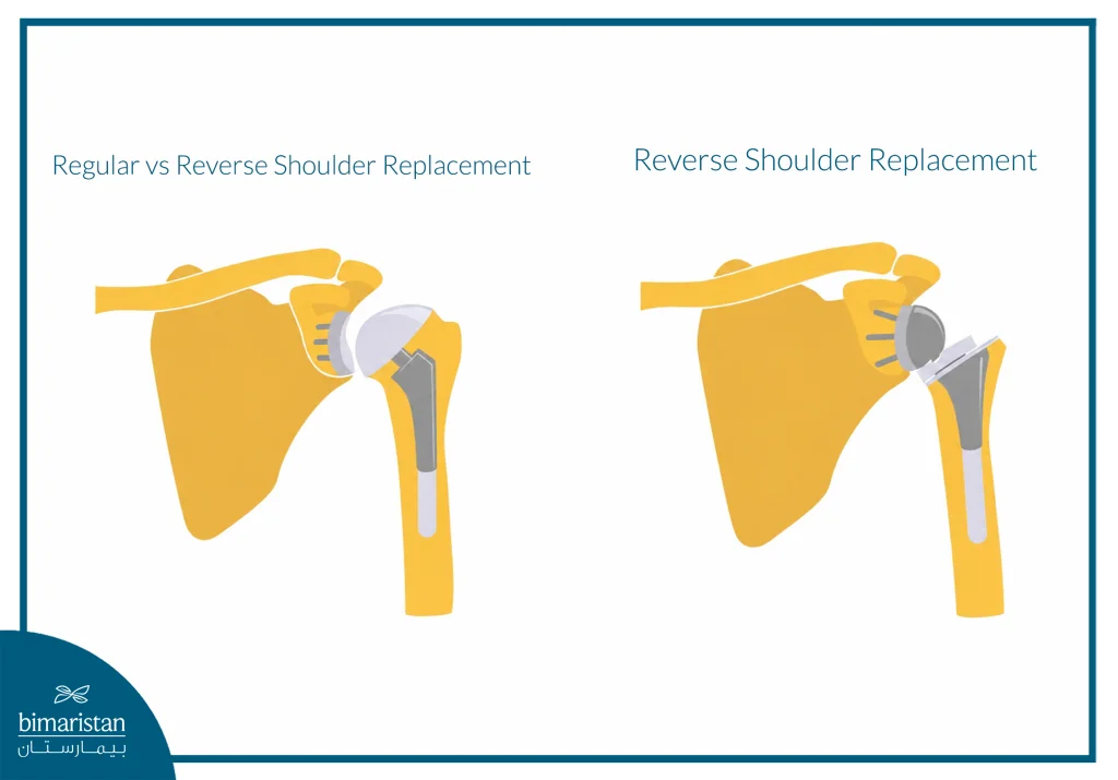 Regular Vs Reverse Shoulder Replacement