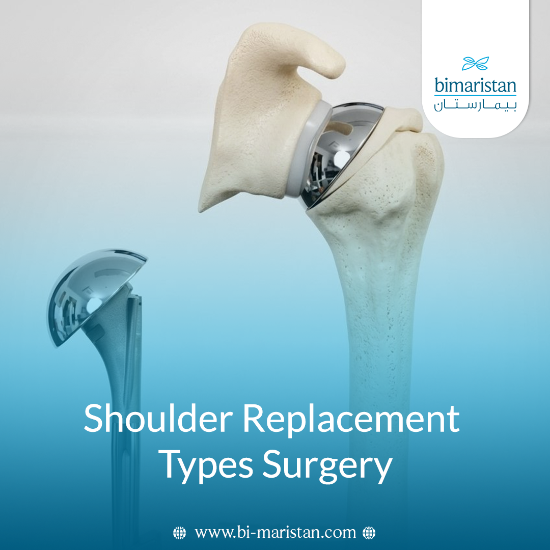 Shoulder Replacement Types Surgery
