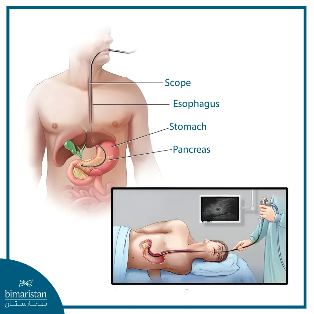 Shows Endoscopic Ultrasound (Eus) Used To Examine The Pancreas Through A Scope Inserted Via The Mouth.
