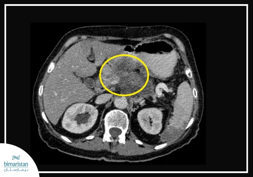 Treatment For Pancreatic Head Cancer: The Latest Surgical Methods And Cure Rates 4 The Image Shows A Ct Scan Of The Abdomen Highlighting A Pancreatic Tumor Used For Diagnosis And Staging Of Pancreatic Cancer.