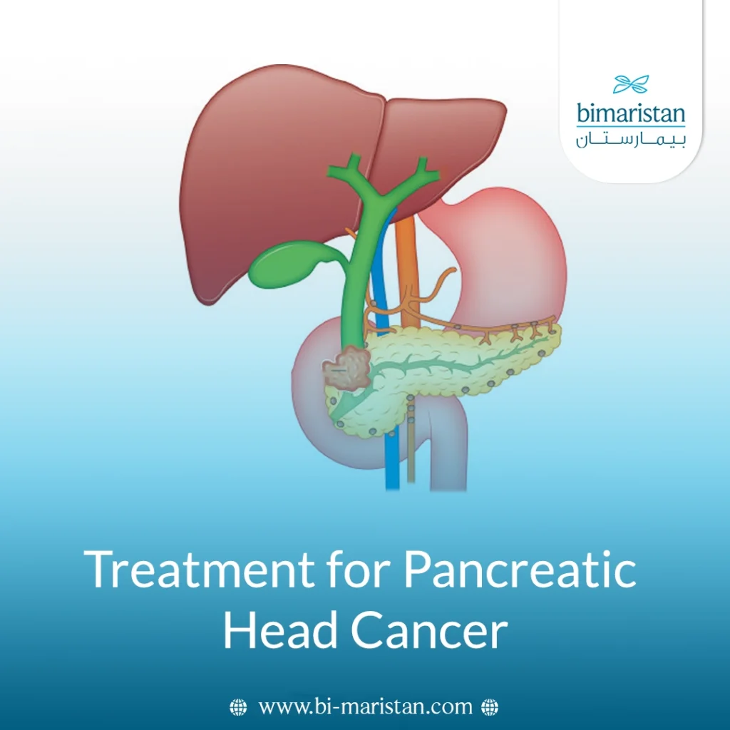 Treatment For Pancreatic Head Cancer: The Latest Surgical Methods And Cure Rates 6 Treatment For Pancreatic Head Cancer