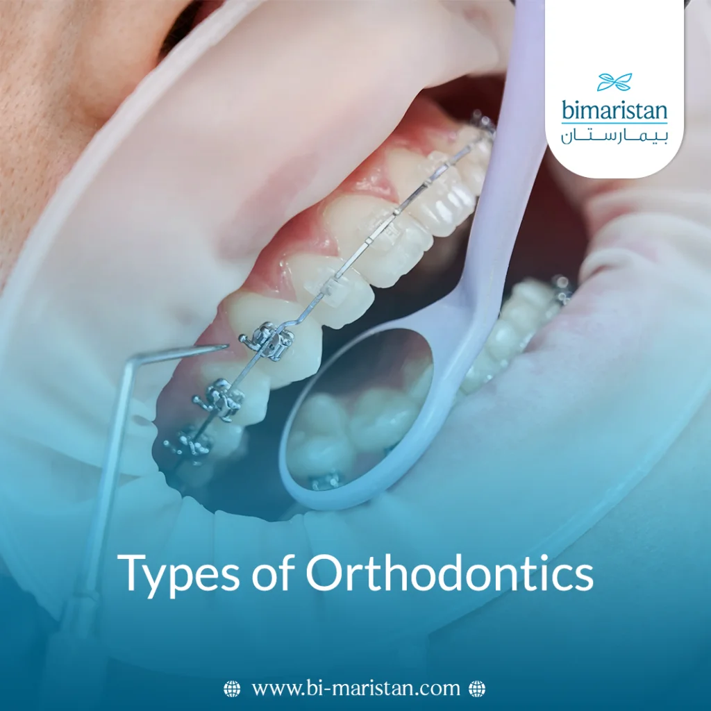 Types Of Orthodontics And Treatment For Malocclusion 4 Types Of Orthodontics