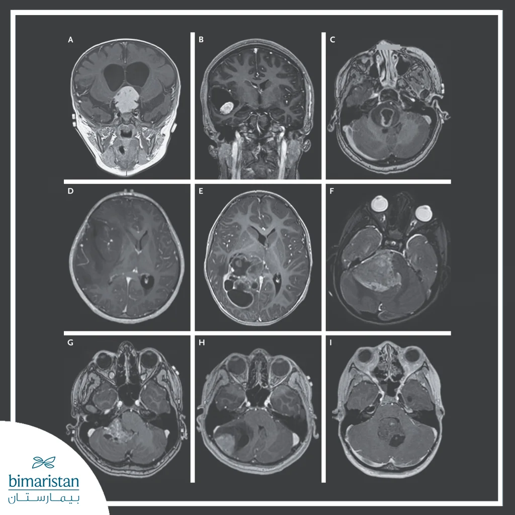 X-Ray Image Showing A Brain Tumor