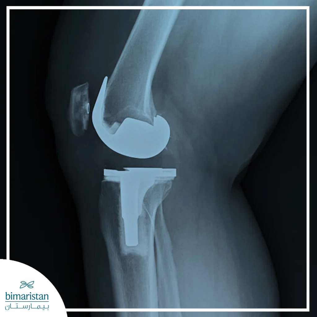 X-Ray Image Showing A Total Knee Replacement.