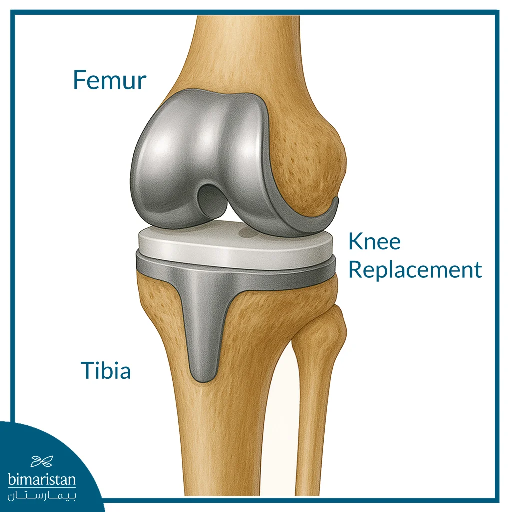 Knee Replacement One Of The Surgical Solutions For Treating Knee Osteoarthritis.