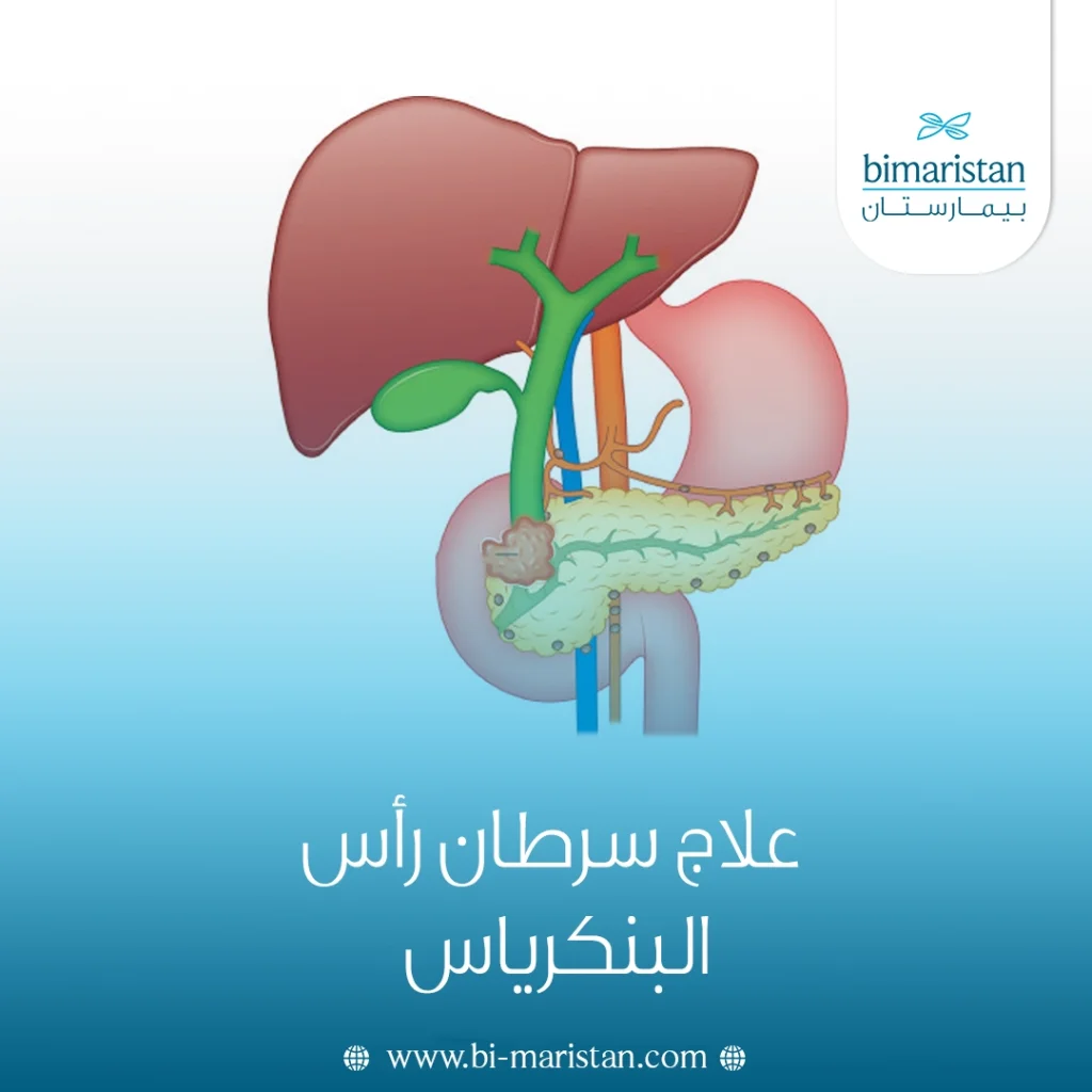 علاج سرطان رأس البنكرياس