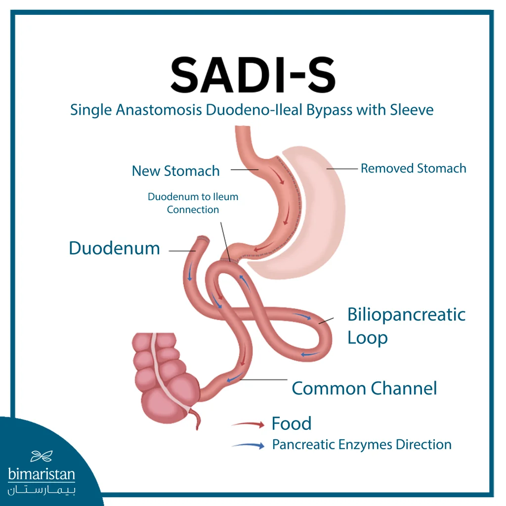 Single Anastomosis Duodeno-Ileal Bypass With Sleeve