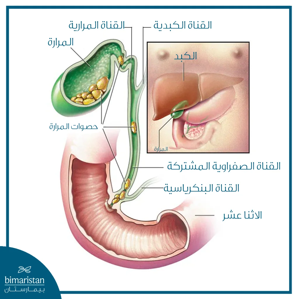 حصوات المرارة داخل المرارة والقنوات الصفراوية