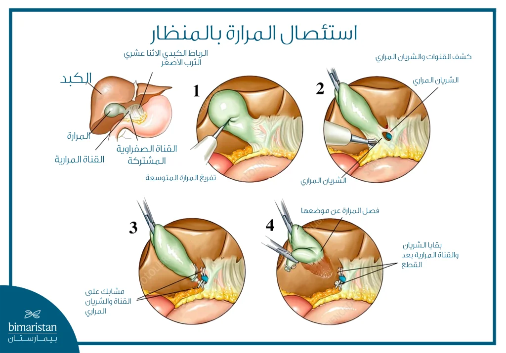 خطوات استئصال المرارة بالمنظار وفصلها عن الكبد