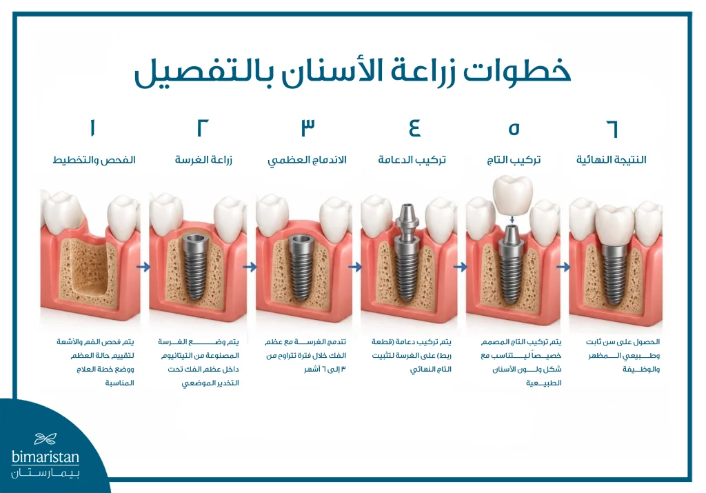 زرعات الأسنان الفرنسية: الميزات والتكلفة 3 خطوات زراعة الأسنان