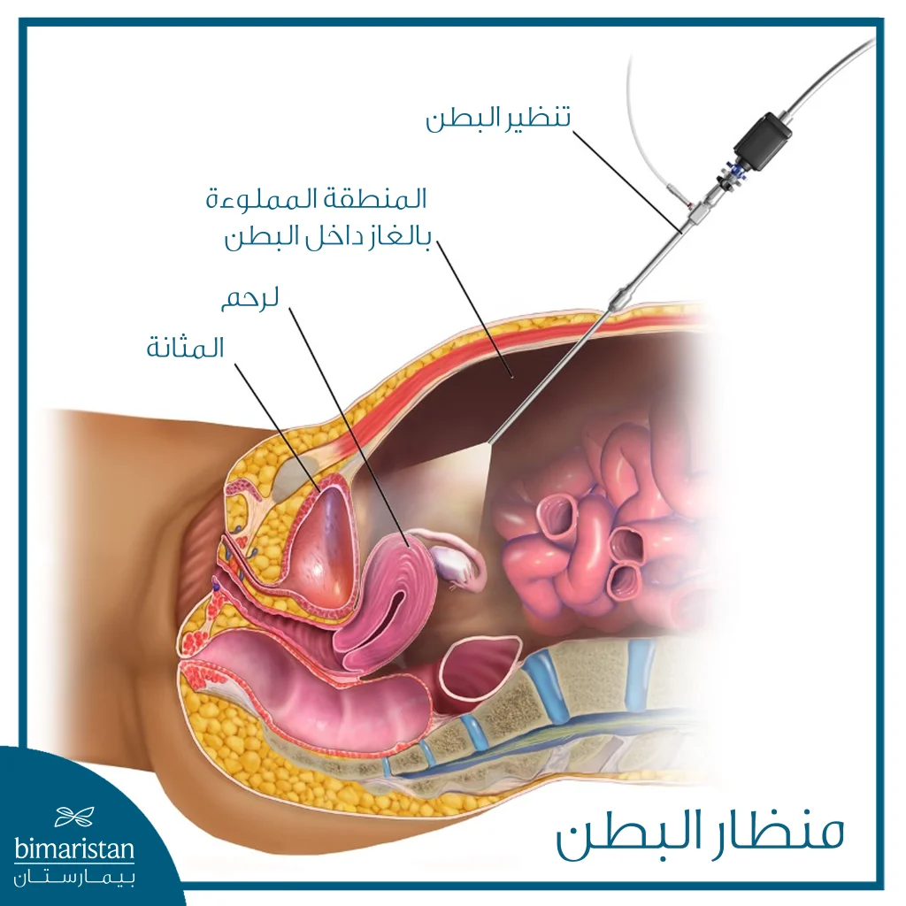 رسم تشريحي يوضّح إدخال منظار البطن عبر شق صغير ومشاهدة الرحم والمثانة بعد توسيع التجويف البطني بالغاز.