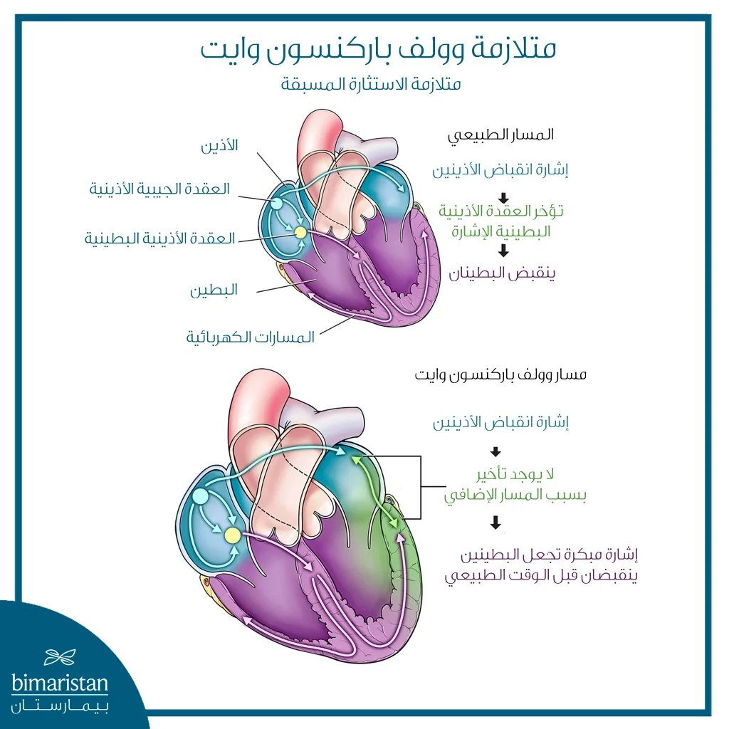 رسم توضيحي يشرح متلازمة وولف باركنسون وايت، ويقارن بين مسار الإشارة الكهربائية الطبيعي في القلب ومسار Wpw الذي