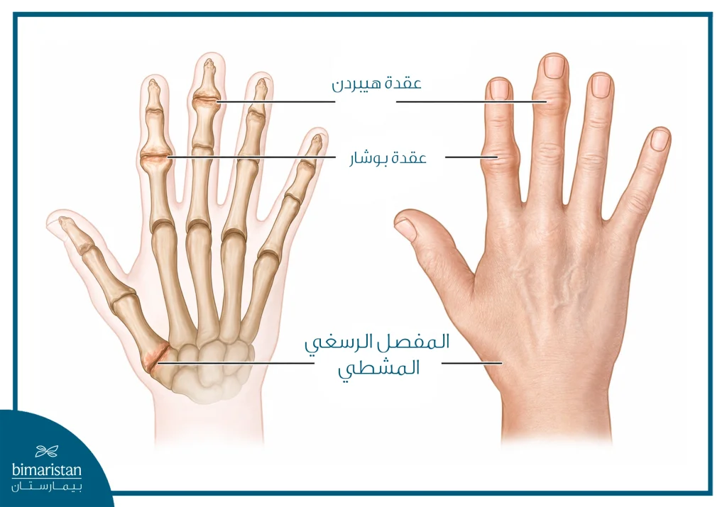 التهاب مفاصل اليد وأنواعه وطرق علاجه 4 صورة اوضح عقد هيبردن وبوشار