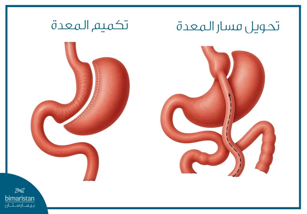 صورة توضح تكميم المعدة وتحويل مسار المعدة
