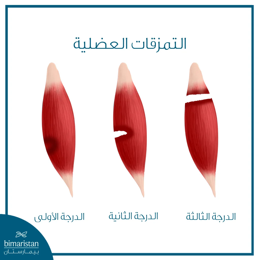 صورة توضح درجات التمزق العضلي